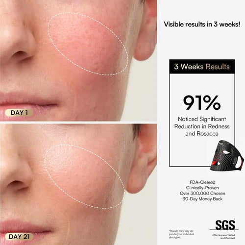 Azora Red-Light Therapy Mask