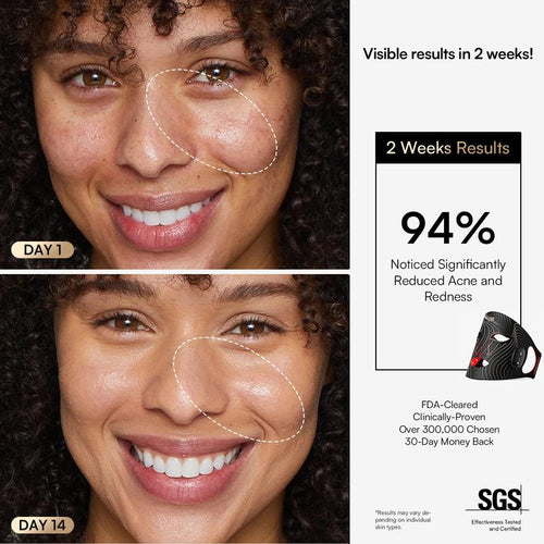 Azora Red-Light Therapy Mask